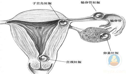 【热点】导致宫外孕的原因有哪些?