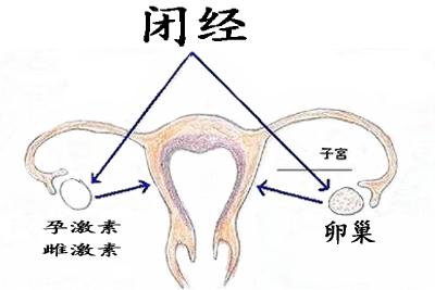 人流后继发性闭经的原因