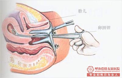 怀孕多久可以做人流?人流最佳时间,你知道吗?