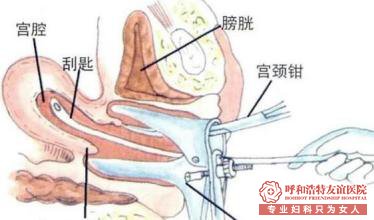 金华婺城区区刮宫手术一般多少钱